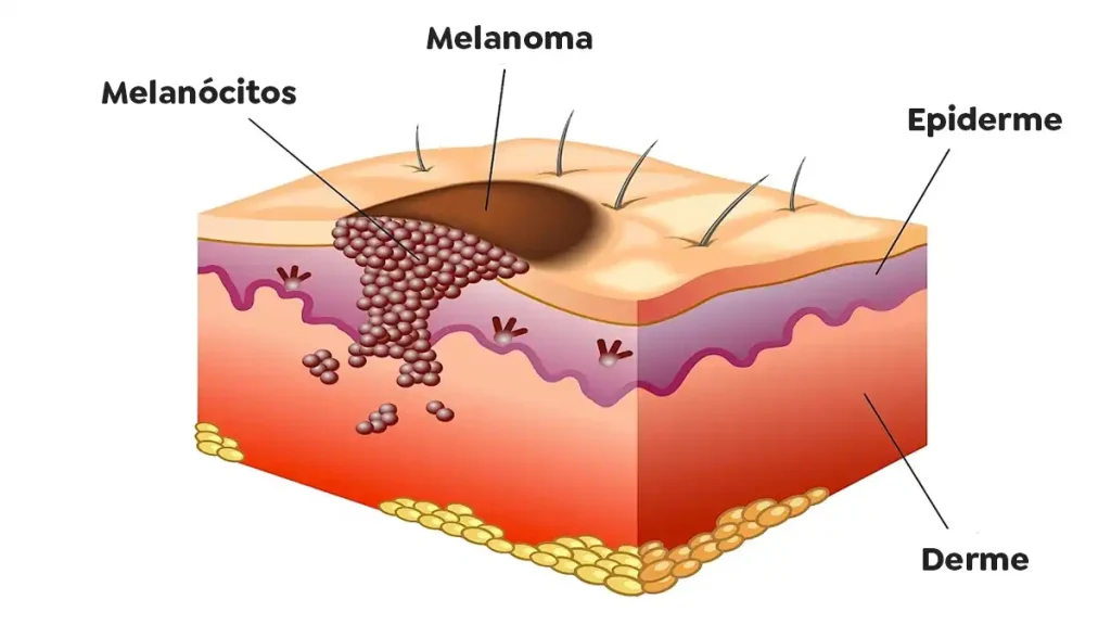 O melanoma tem cura?